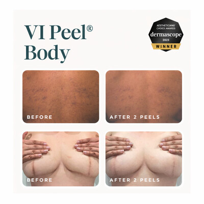 VI Peel® - Body